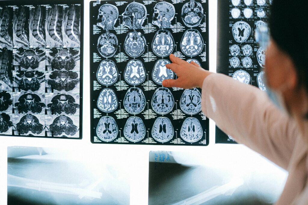 A doctor examines a series of brain MRIs on a lightbox, pointing at the images. The room is clinical, conveying focus and analysis.
